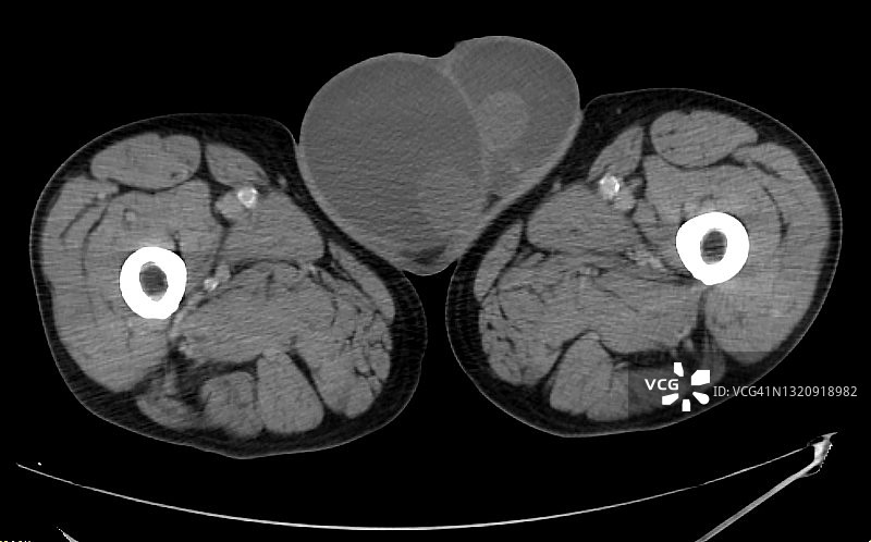 计算机断层扫描轴位显示的双侧鞘膜积液图片素材