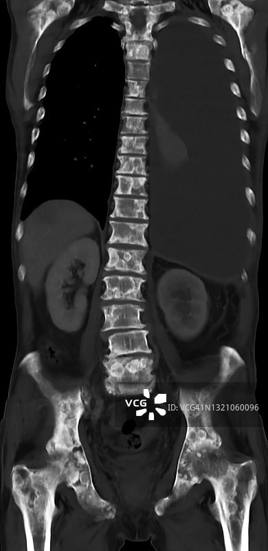 CT计算机断层扫描显示的脊柱转移，癌细胞扩散到胸腰椎和骨盆（冠状面）图片素材