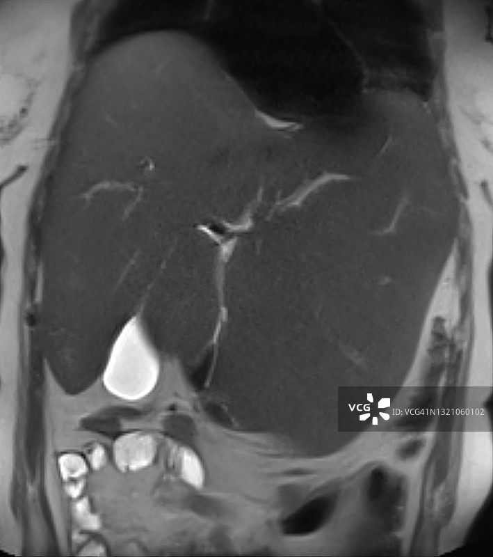 冠状MRI T2图像上的肝肿大图片素材