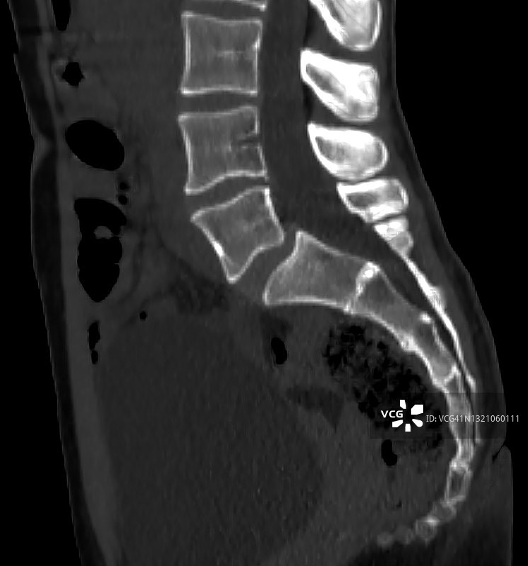 腰椎CT显示L5-S1椎体滑脱（侧位图）图片素材