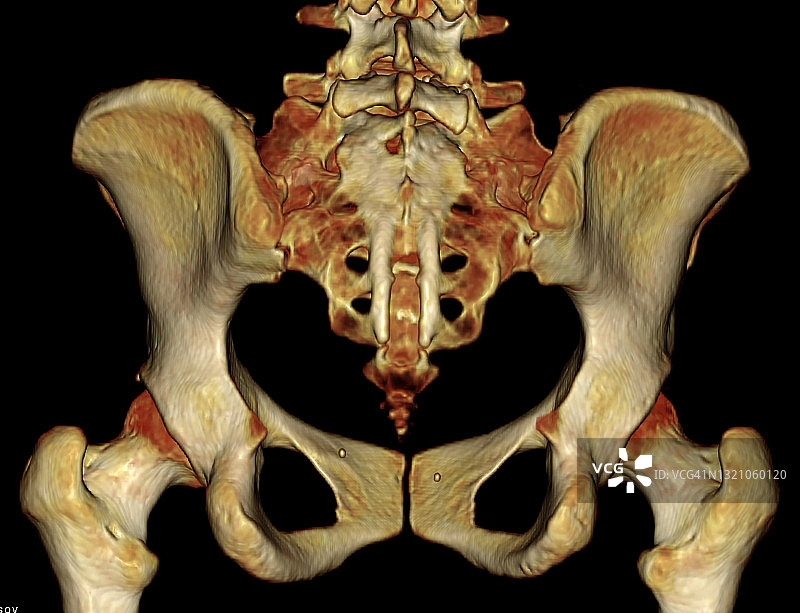骶骨隐性脊柱裂CT扫描，骨盆与髋关节3D渲染图像后视图图片素材