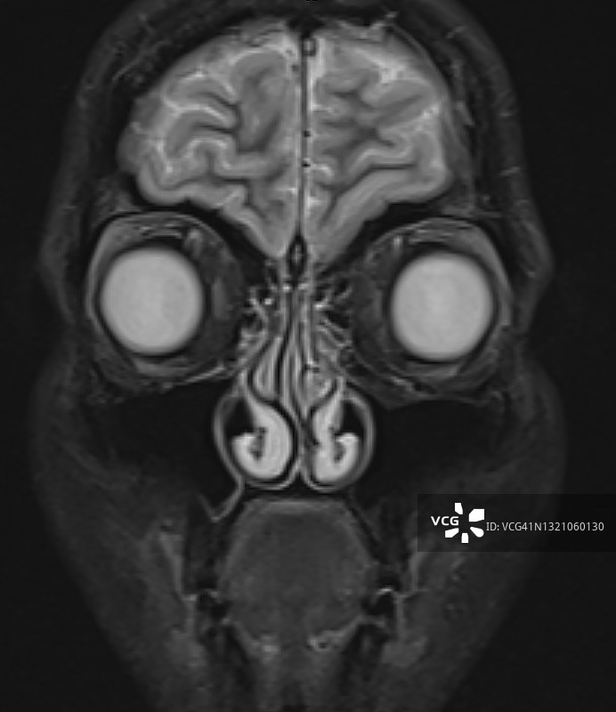 头部面部磁共振 coronal STIR图像图片素材