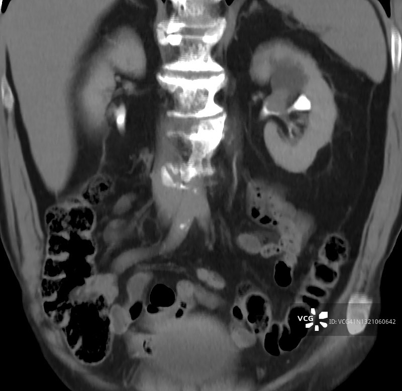 左肾肾盂输尿管癌图片素材