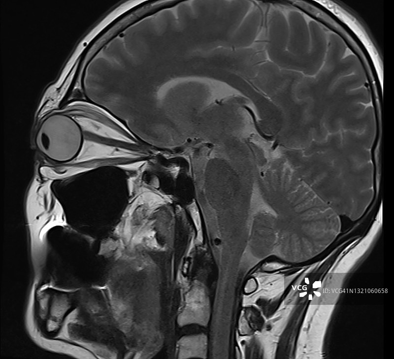 头部MRI扫描：眼睛、大脑和鼻子的矢状T2图像图片素材
