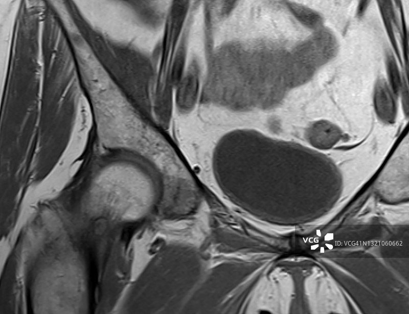 股骨近端骨样骨瘤的MRI影像图片素材