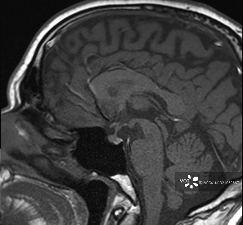 头部核磁共振扫描，显示眼睛、大脑和鼻子，矢状T1图像图片素材