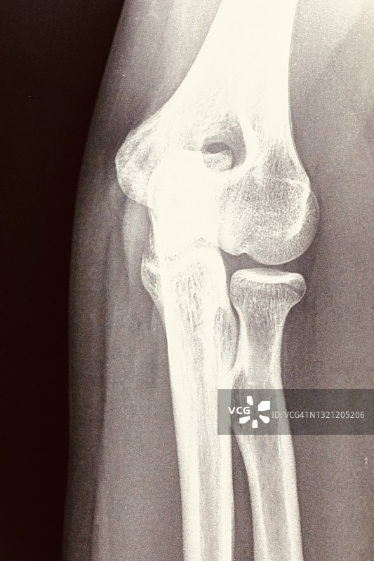 人体X光片图片素材