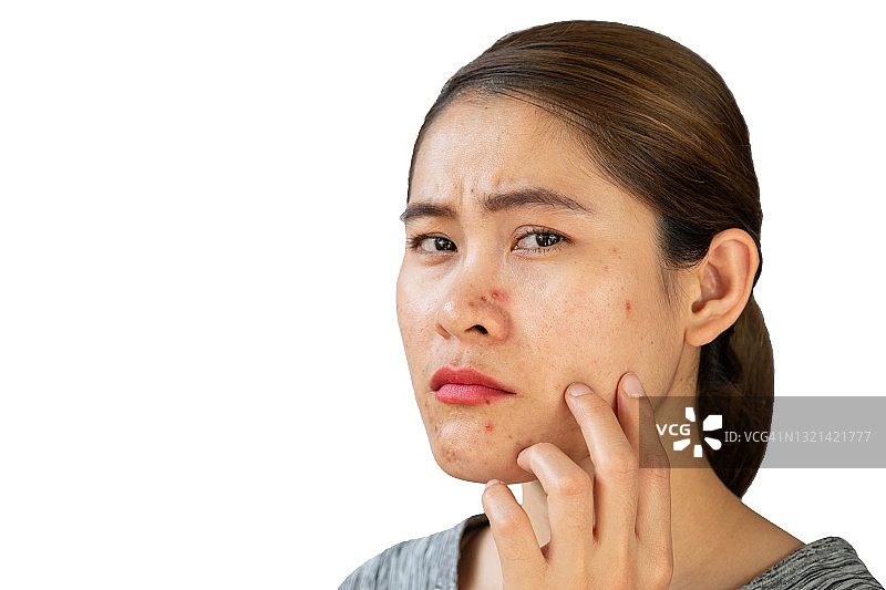 面部痤疮发炎的亚洲忧虑女性肖像图片素材