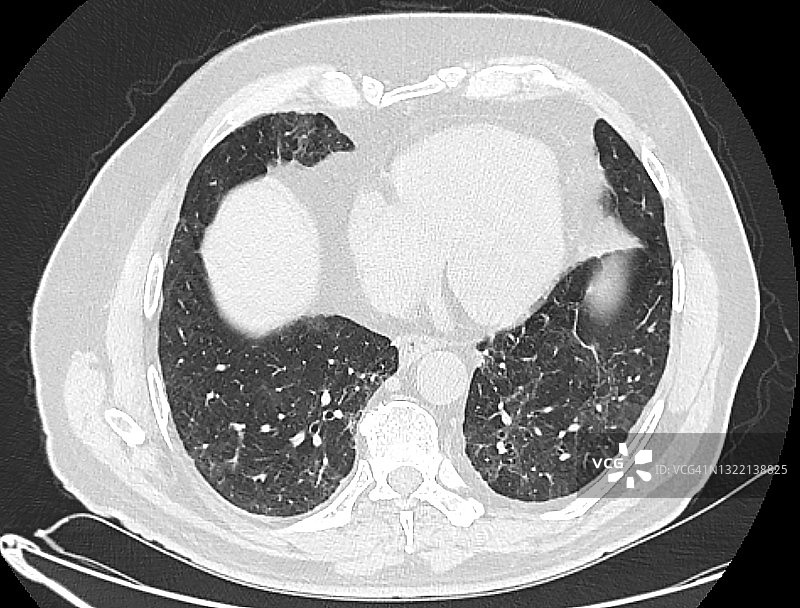 肺部多处感染部位的COVID-19图片素材