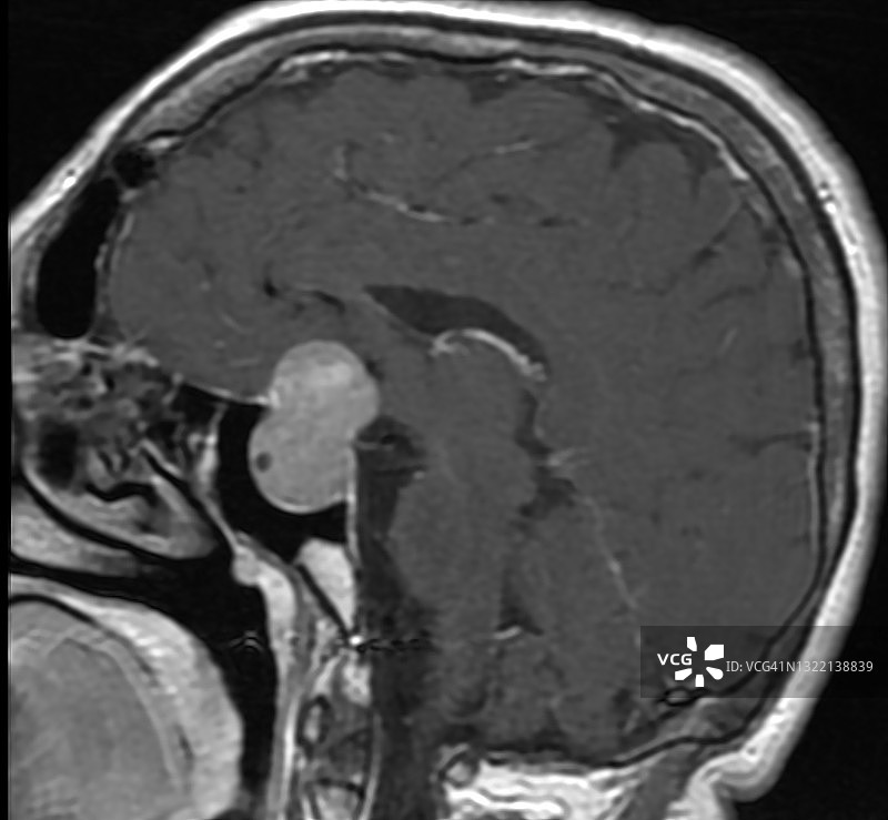 脑部磁共振成像（MRI）扫描，使用钆（GD）对比剂注射，矢状视图，垂体肿块病例图片素材