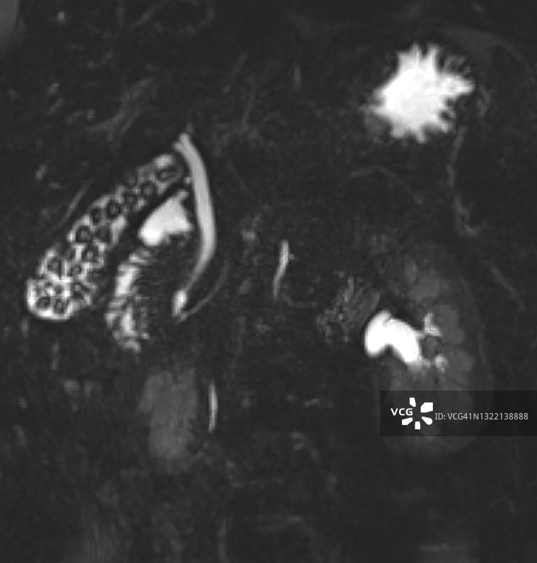 在冠状磁共振图像（MRI）上看到的胆结石图片素材