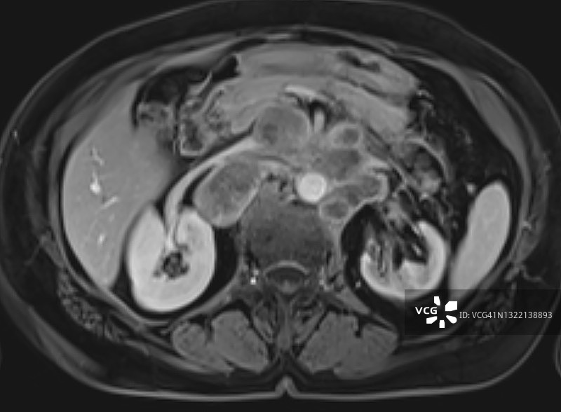 MRI磁共振图像显示的扩大的腹膜后淋巴结，轴位T1加钆后图像图片素材