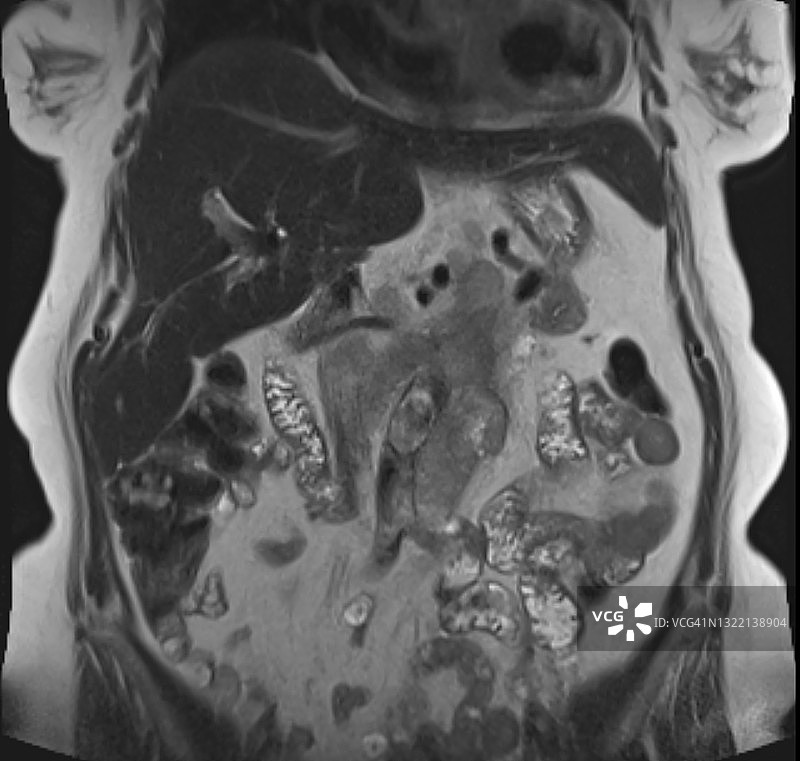 MRI磁共振图像上显示的增大的腹膜后淋巴结图片素材