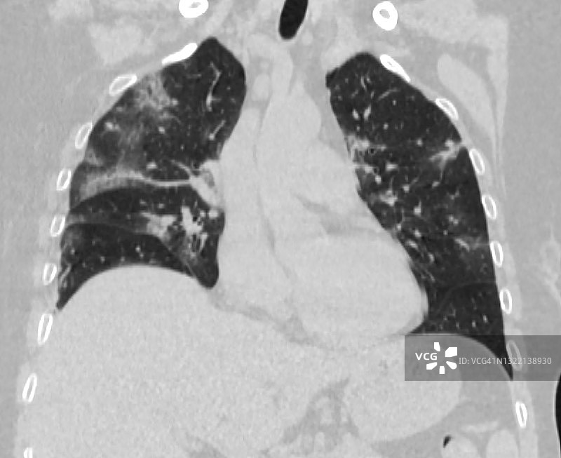 在重症监护室拍摄的COVID-19患者的肺部CT扫描图片素材