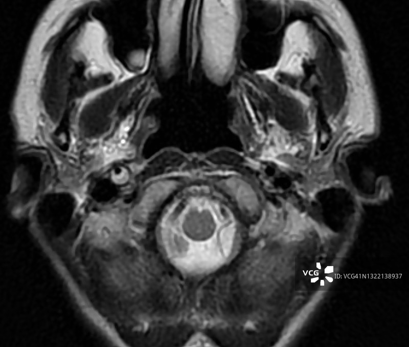 右侧颈动脉夹层血管壁T2高信号新月征MRI图像图片素材