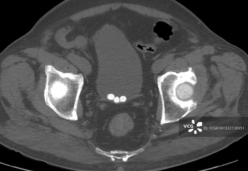 轴向CT计算机断层扫描图像上的膀胱结石图片素材