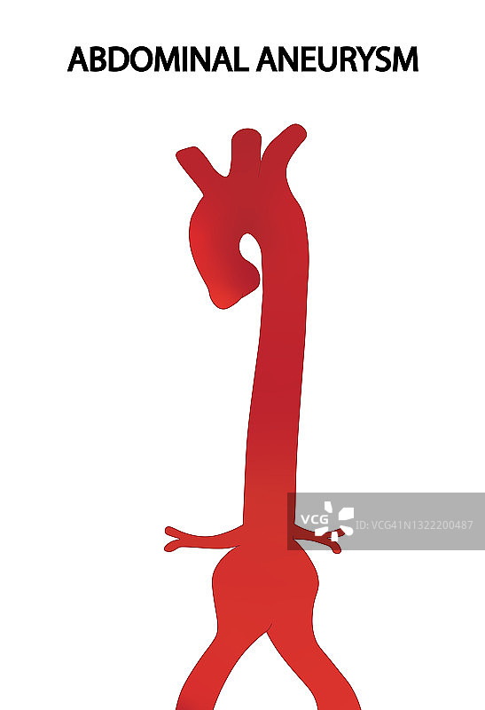 腹主动脉瘤图示图片素材