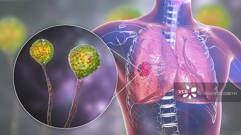 肺毛霉菌病插图图片素材