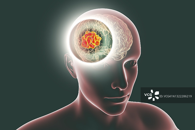 毛霉菌病大脑图示图片素材