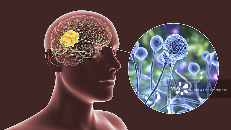 毛霉菌病大脑图示图片素材