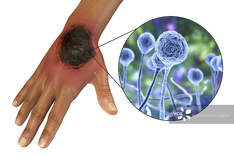 皮肤毛霉菌病插图图片素材