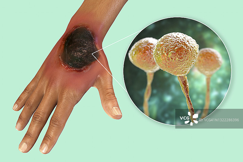 皮肤毛霉菌病插图图片素材