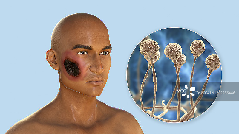 皮肤毛霉菌病插图图片素材