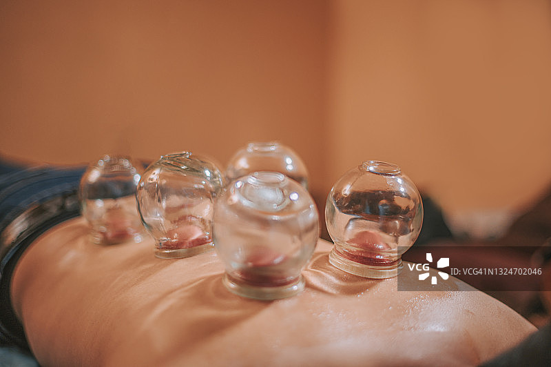 亚洲中国男性患者在中医诊所接受真空拔罐疗法图片素材