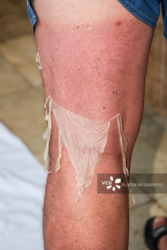 晒伤的腿图片素材