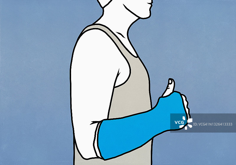 手臂打着石膏的男人竖起大拇指图片素材