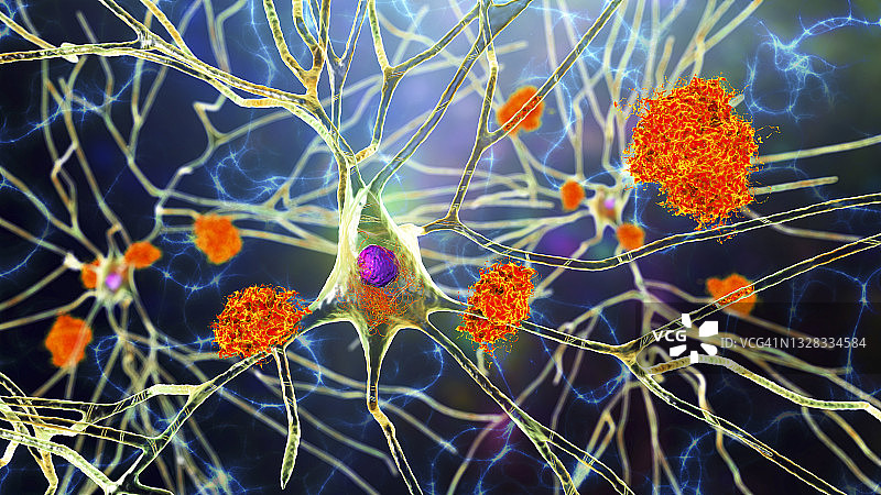 受阿尔茨海默病影响的神经细胞插图图片素材