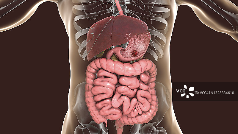 胃溃疡插图图片素材