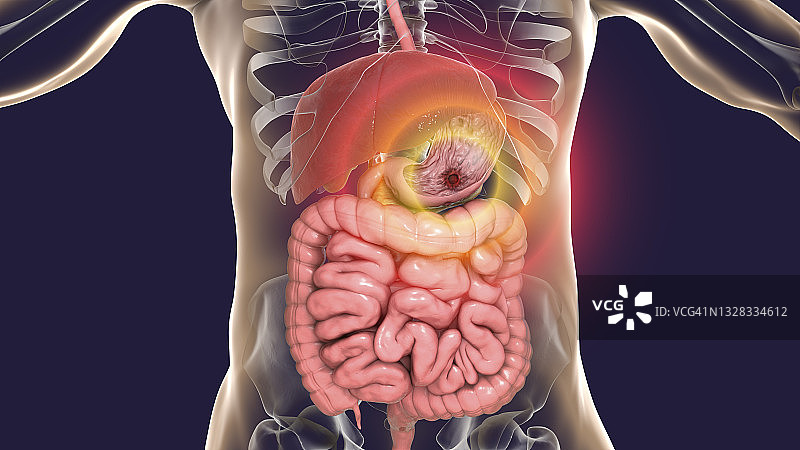 胃溃疡插图图片素材