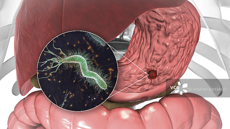 胃溃疡和幽门螺杆菌图示图片素材