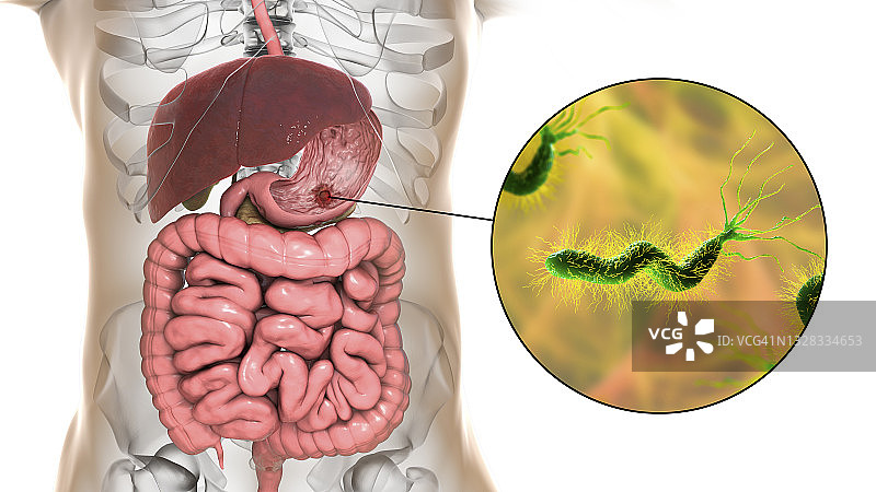 胃溃疡和幽门螺杆菌图示图片素材