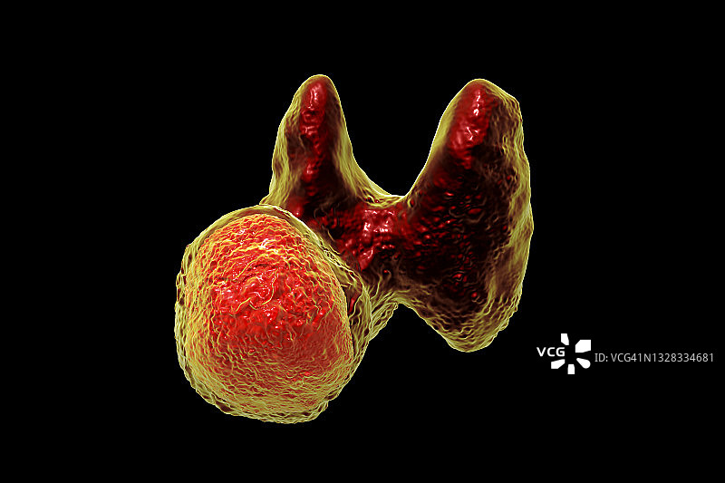 甲状腺肿瘤插图图片素材
