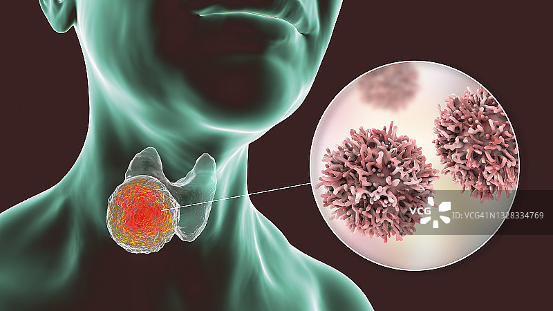 甲状腺癌插图图片素材