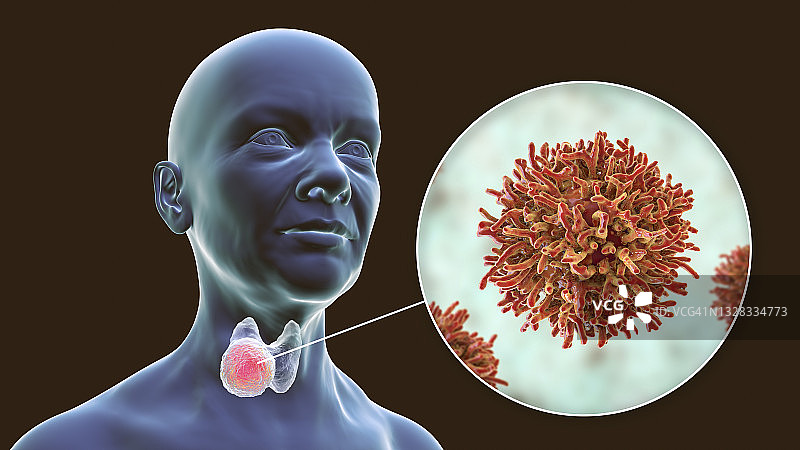 甲状腺癌插图图片素材