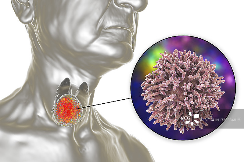 甲状腺癌插图图片素材