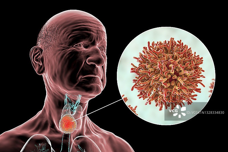 甲状腺癌插图图片素材