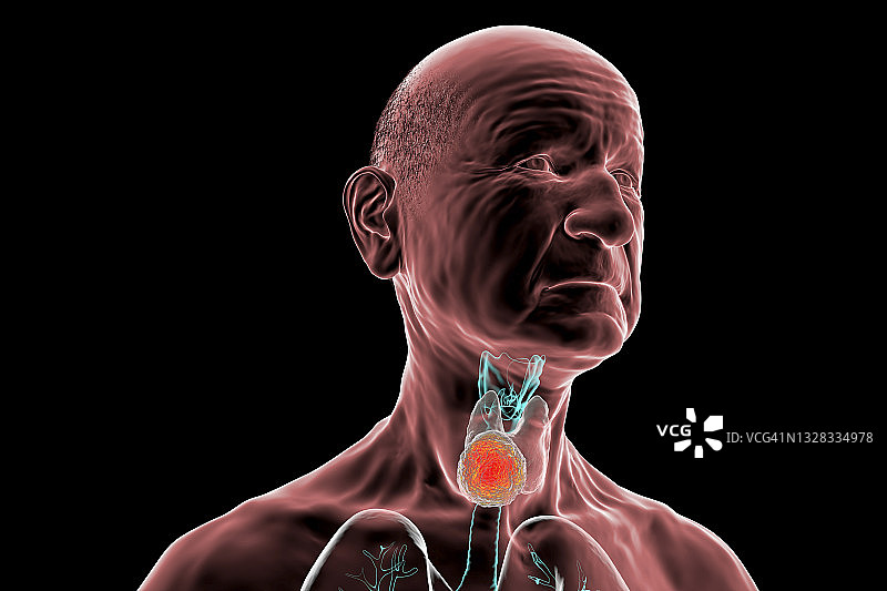甲状腺肿瘤插图图片素材