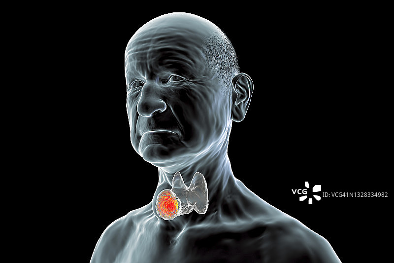 甲状腺肿瘤插图图片素材