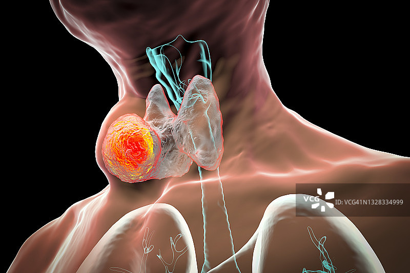 甲状腺肿瘤插图图片素材