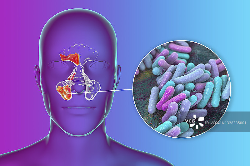 鼻窦炎插图图片素材