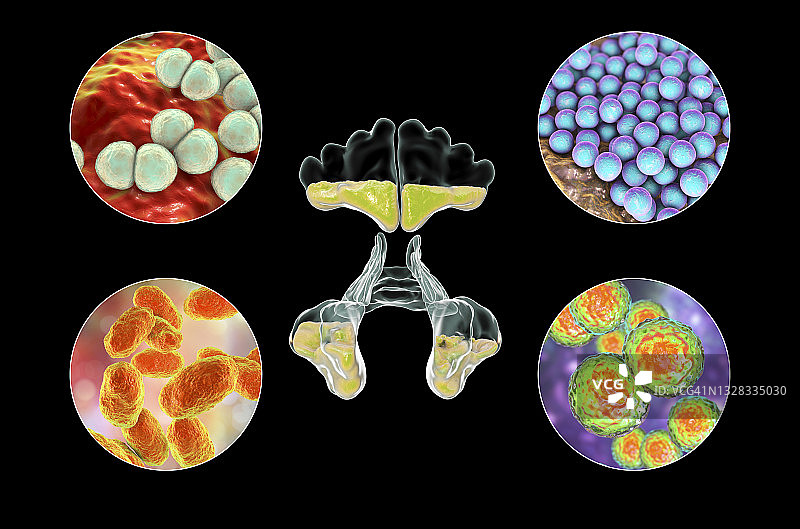 鼻窦炎插图图片素材