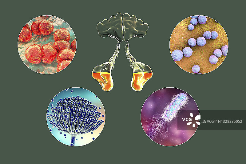 鼻窦炎插图图片素材