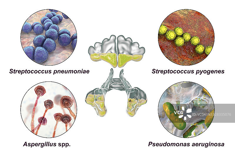 鼻窦炎插图图片素材