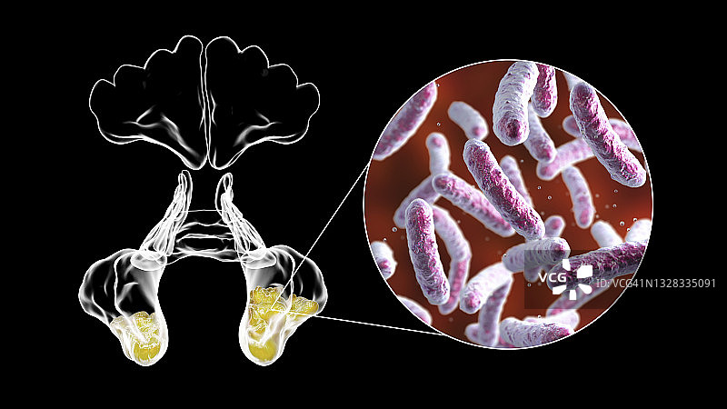 鼻窦炎插图图片素材