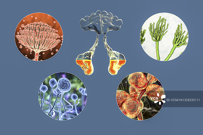 鼻窦炎插图图片素材