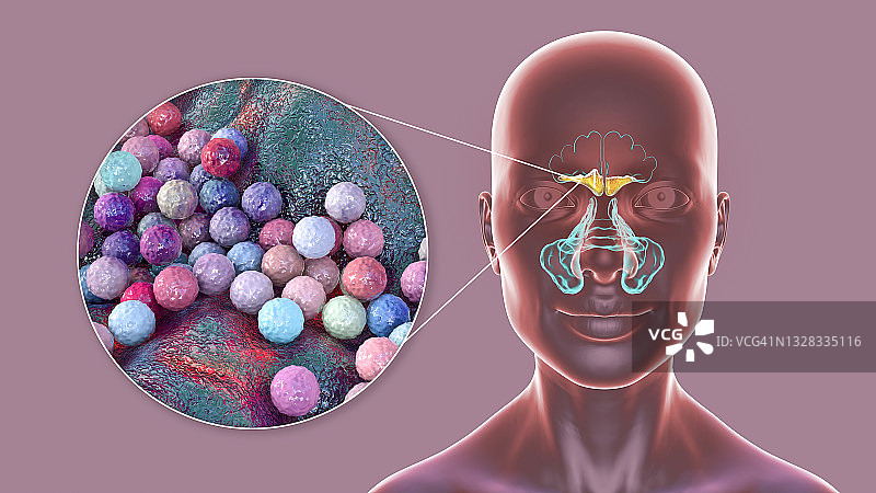 鼻窦炎插图图片素材